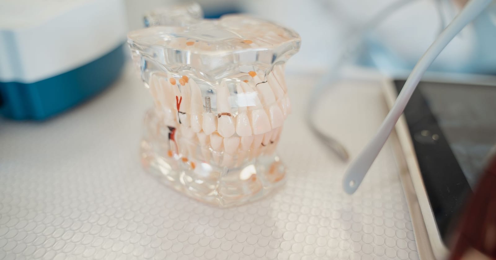 All on 4 Dental Implants: Complete Patient Guide