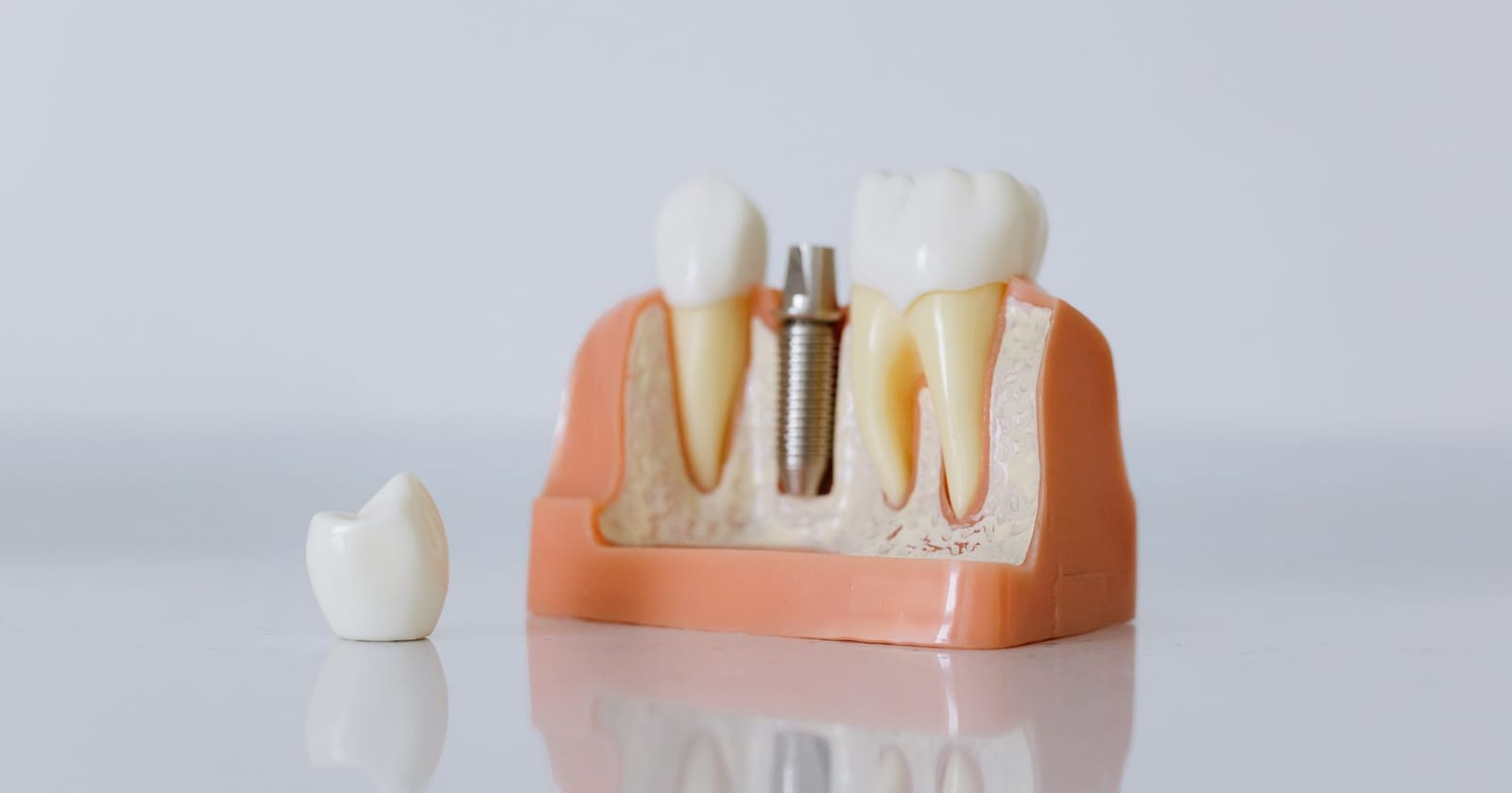 Dental Implants and Dentures: Which Is Right for You?